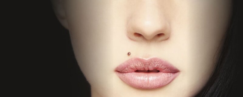 Появилось много родинок после ожога