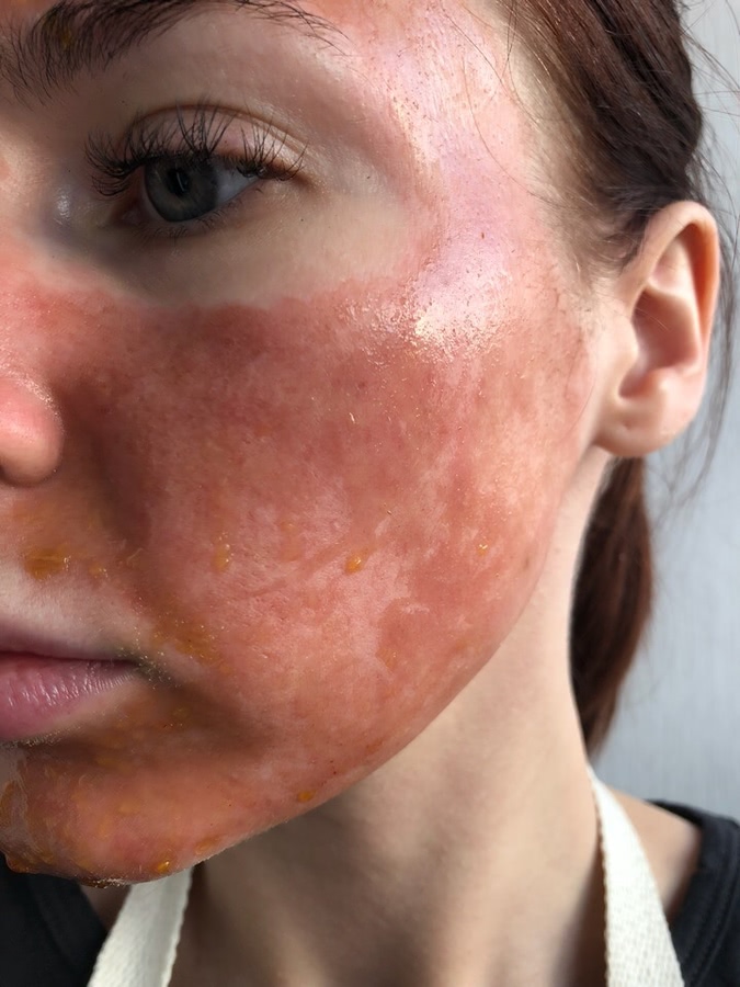 Лазерная шлифовка ожога 3 степени