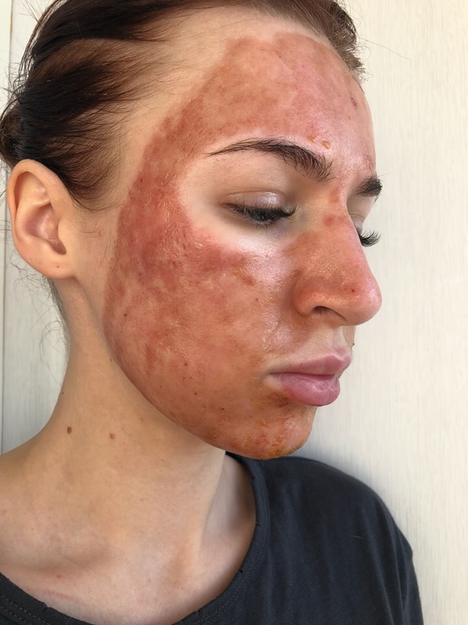 Лазерная шлифовка ожога 3 степени