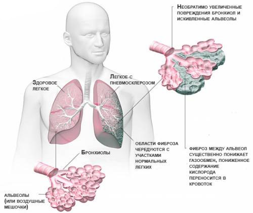 Начальная фаза интерстициальной пневмонии проявляется