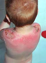 Lechenie_solnechnikh_ozhogov_v_domashnikh_usloviyakh_u_detey