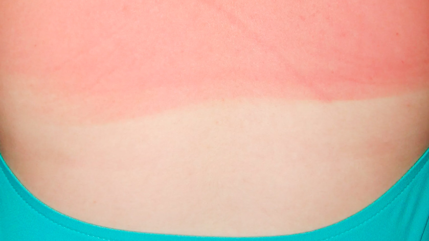 Ожог первой степени - виды ожогов. Стерильно.com