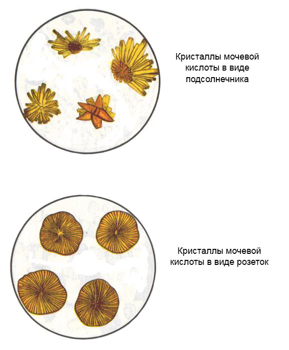 кристаллы мочевой кислоты