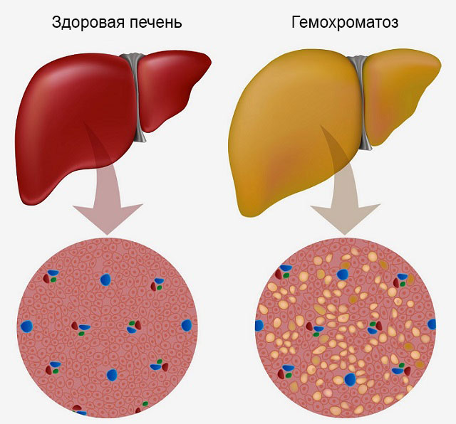гемохроматоз