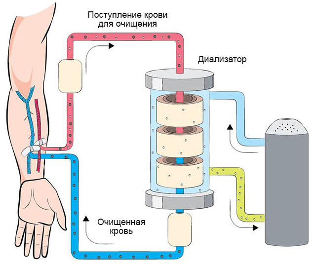 гемодиализ