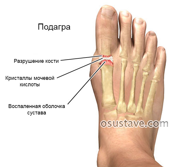 подагра