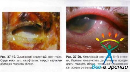 Ожог глаз код мкб 10