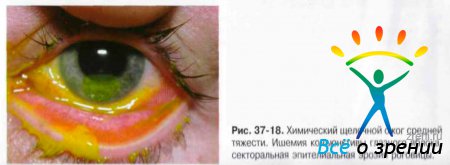 Ожог глаз код мкб 10