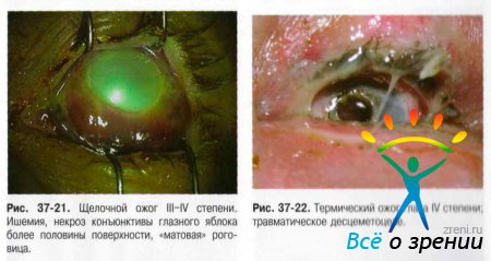 Ожог глаз код мкб 10