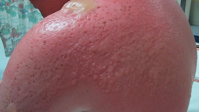 Сильный ожог кипятком