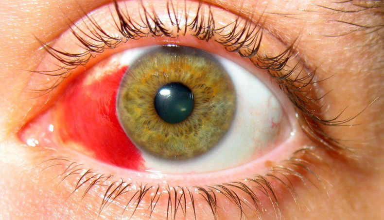 Ожоги глаз Ожоги глаз