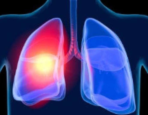 ожог дыхательных путей