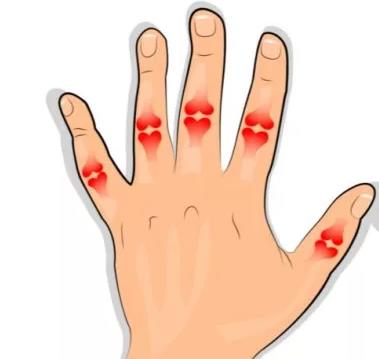 Что такое подагра локтей и как ее лечить