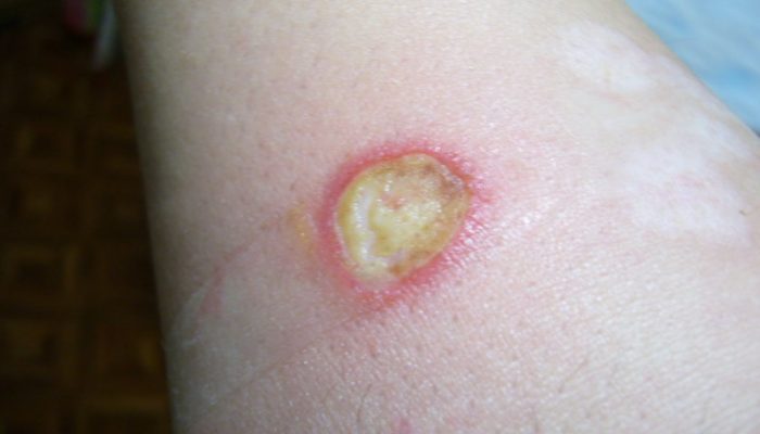 После ожога кожа покрывается коркой