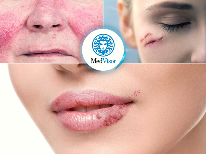 противопоказания для пилинга Чем убрать ожог от салициловой кислоты