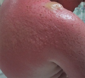 Lechenie_solnechnikh_ozhogov_v_domashnikh_usloviyakh_u_detey