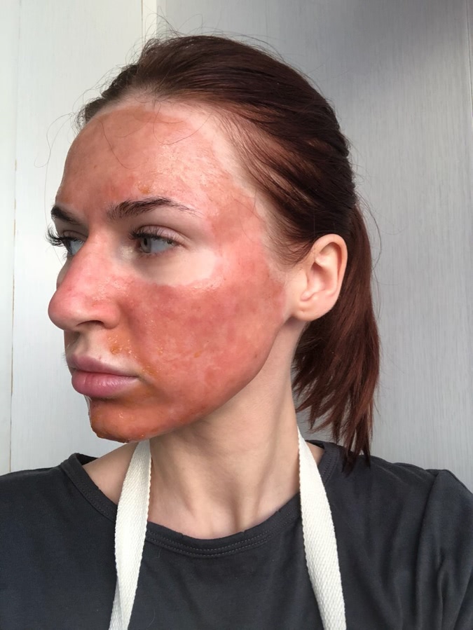 Лазерная шлифовка ожога 3 степени