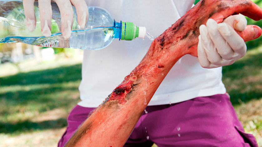 Ожог четвертой степени - виды ожогов. Стерильно.com