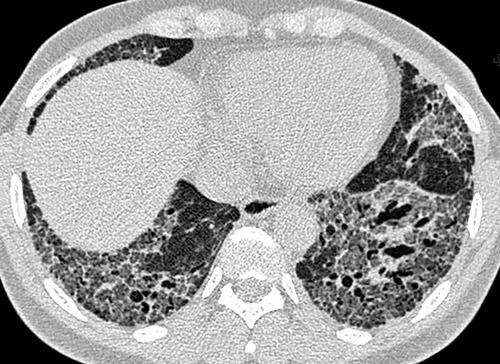 Начальная фаза интерстициальной пневмонии проявляется