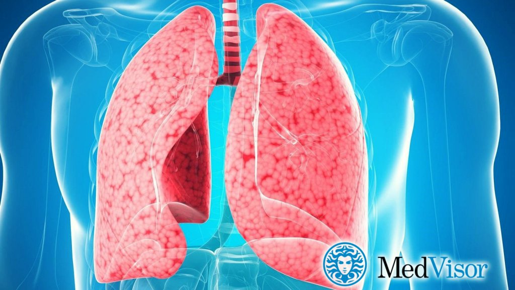 Может ли бронхит перейти в пневмонию? Можно ли бронхит перепутать с пневмонией на рентгене