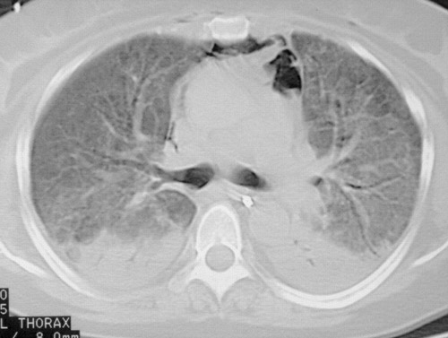 Начальная фаза интерстициальной пневмонии проявляется