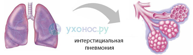 Начальная фаза интерстициальной пневмонии проявляется