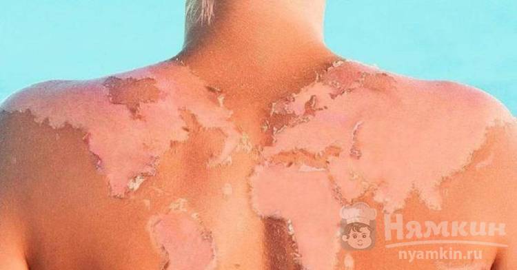 Что сделать чтобы после солнечного ожога не облезла кожа