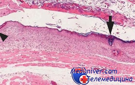 изменения кожи при ожоге