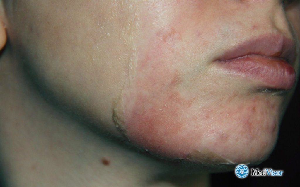 Ожог после салицилового пилинга Чем убрать ожог от салициловой кислоты