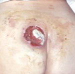 Пролежень Пролежень