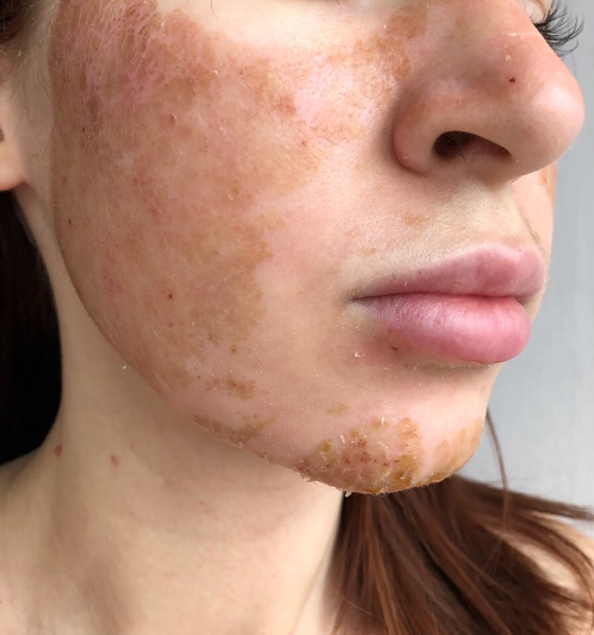 Лазерная шлифовка ожога 3 степени