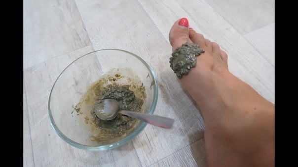 Подагра пятки признаки и лечение Подагра пятки признаки и лечение thumbnail