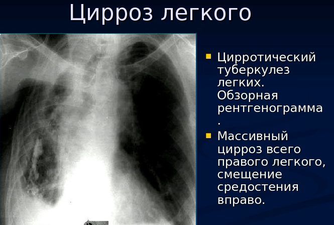 Осложнением пневмонии является цирроз легкого