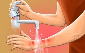 Как избавиться от боли после ожога на руке