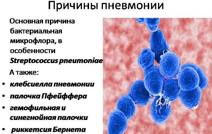 Причины воспаления легких