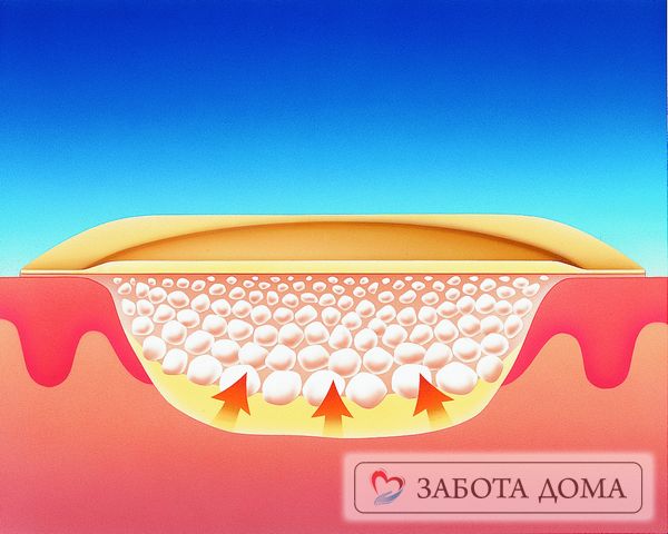 Всем изделиям свойственно адсорбировать экссудат из язвы и способствовать ускорению заживления Действие повязки от пролежней