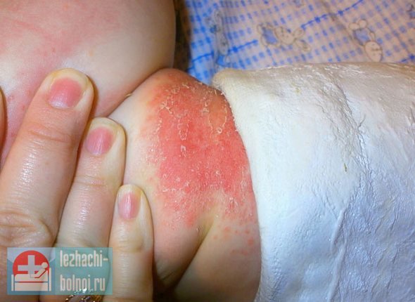 И, если степень плотности прилегания повязки может контролировать только врач при наложении гипса, остальные моменты контролируются лицами, осуществляющими уход за лежачим больным. Пролежень или раздражение под гипсом