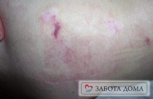 Начальная стадия пролежней Начальная стадия пролежней