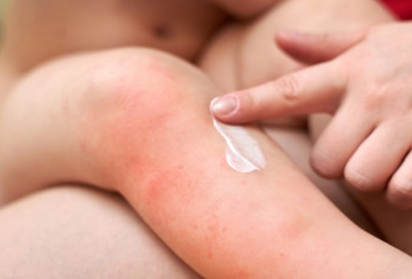 Ребенку наносят мазь на ножку