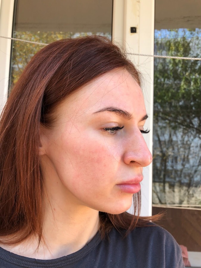 Лазерная шлифовка ожога 3 степени