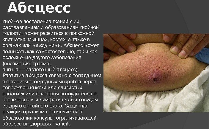 Абсцесс