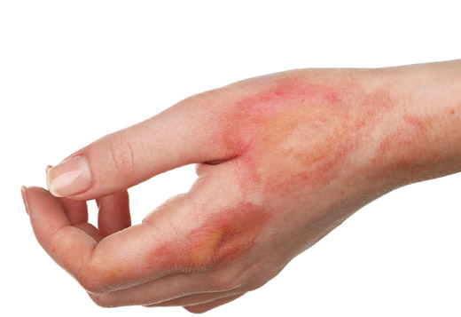 ожог на руке