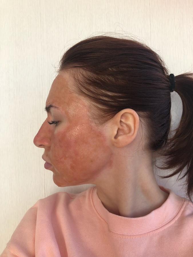 Лазерная шлифовка ожога 3 степени