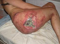 Пролежень Пролежень