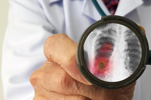 Сколько человек умерло от пневмонии