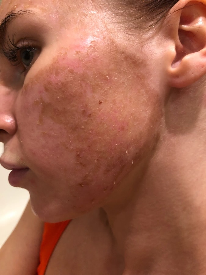 Лазерная шлифовка ожога 3 степени