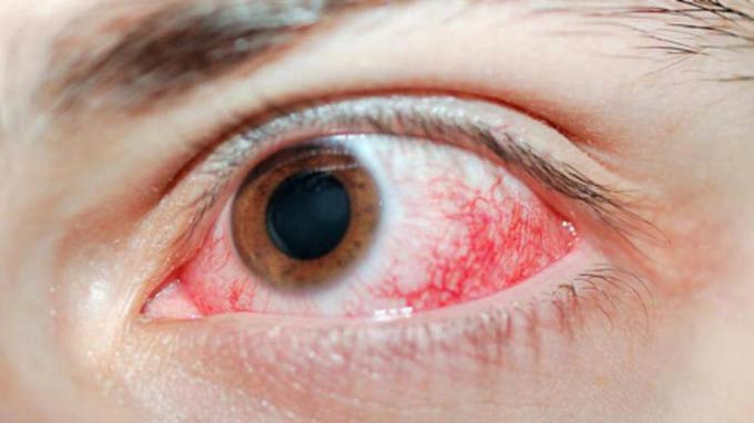 химический ожог глаза