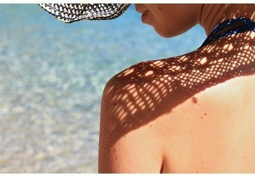 Опасная родинка на спине
