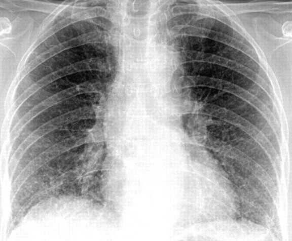 Ребенок 2 года пневмония снимок Ребенок 2 года пневмония снимок thumbnail