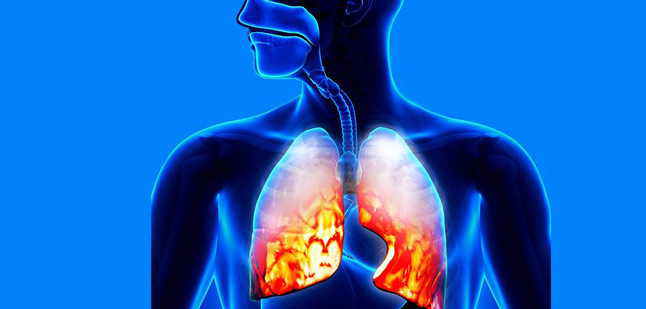 Как развивается воспаление легких. Как развивается воспаление легких.